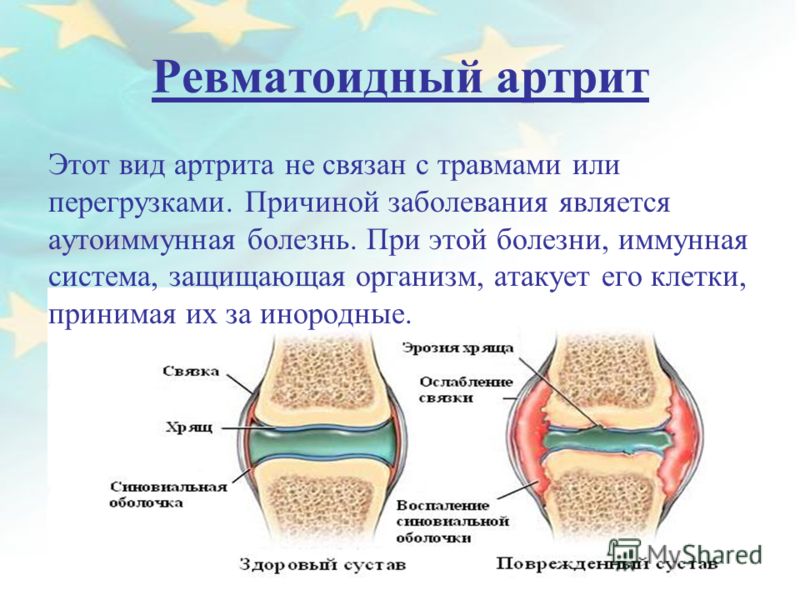 Презентация На Тему Ревматоидный Артрит Презентация На Тему Ревматоидный Артрит
