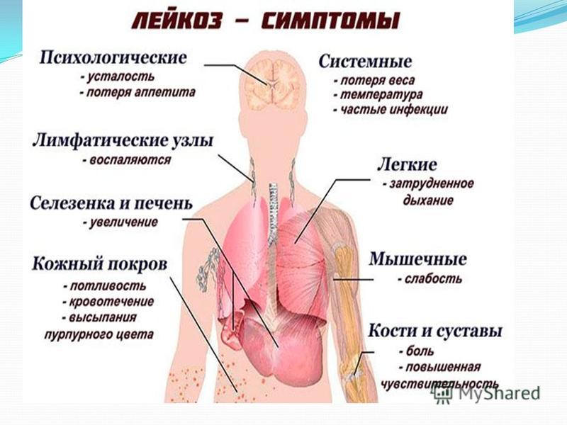 Как выглядят люди с раком крови Лейкоз фото - ViktoriaFoto.ru