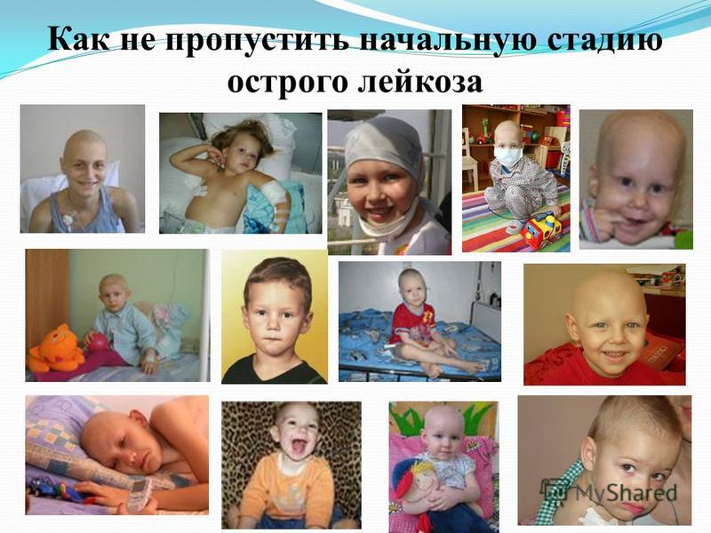 Как проявляется острый лейкоз (рак крови) у детей? Онкогематология Дзен