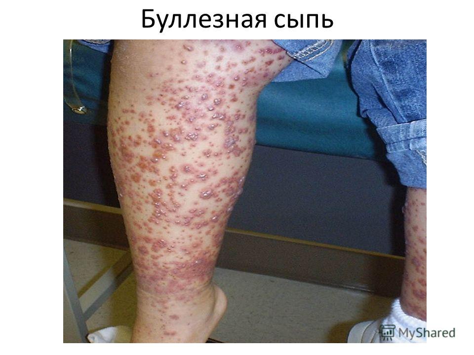 Болит когда нажимаешь справа от пупка