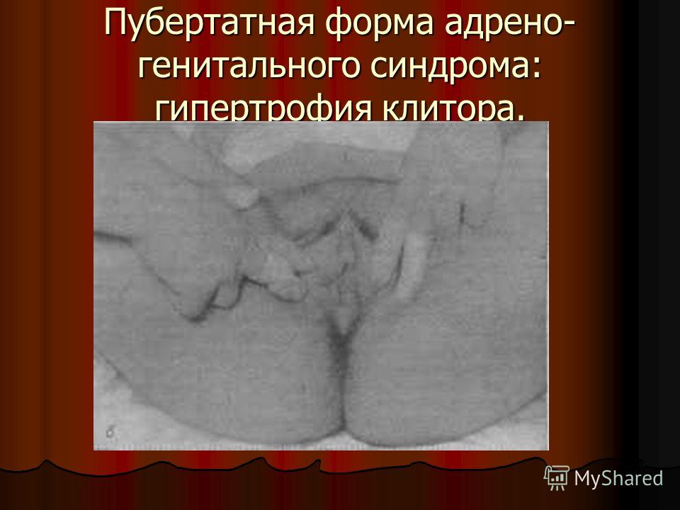 Формы клитора Формы клитора