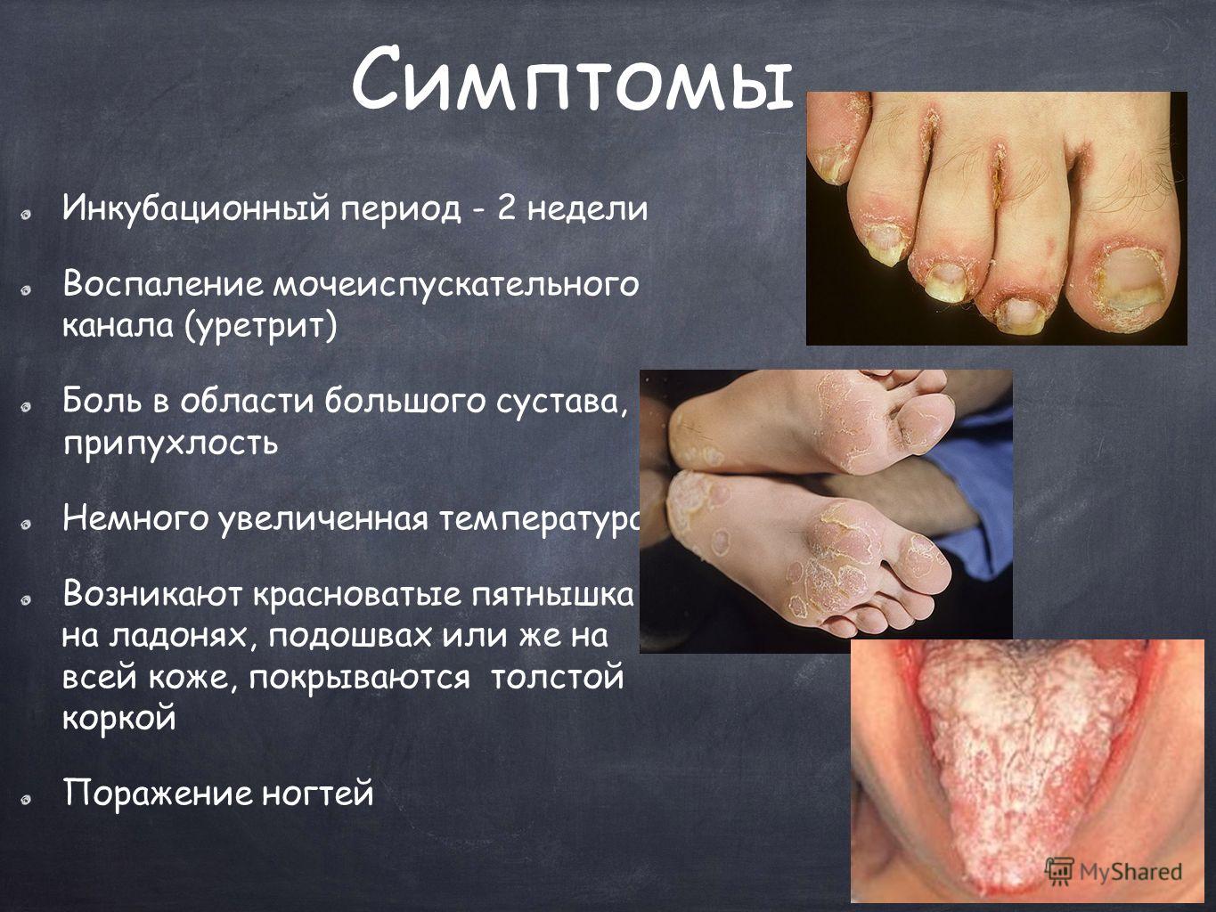 Препараты для воспаления простаты Препараты для воспаления простаты