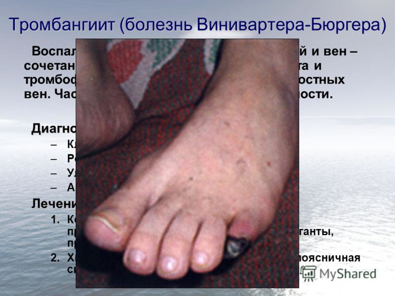 Боли в суставов ног