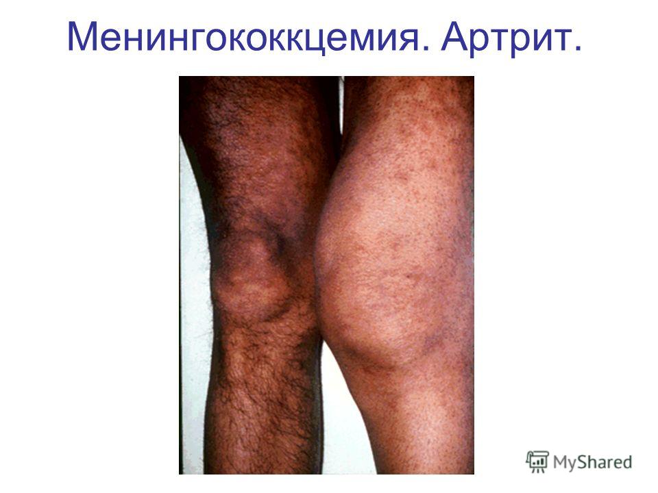 Презентация На Тему Артрит Презентация На Тему Артрит