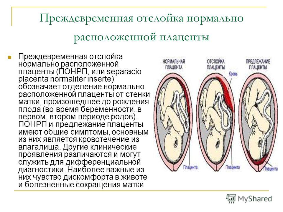 профилактика Преждевременной отслойки нормально расположенной плаценты