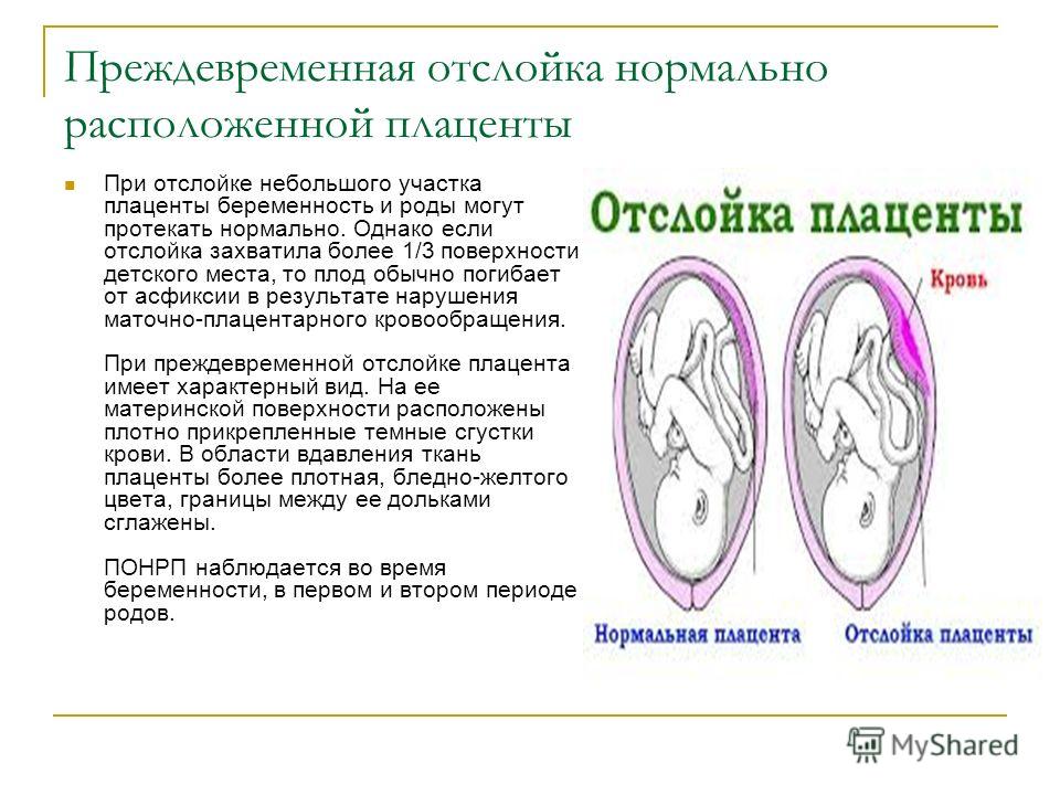 Консультация врача гинеколога в МосквеПреждевременная отслойка нормально расположенной плаценты