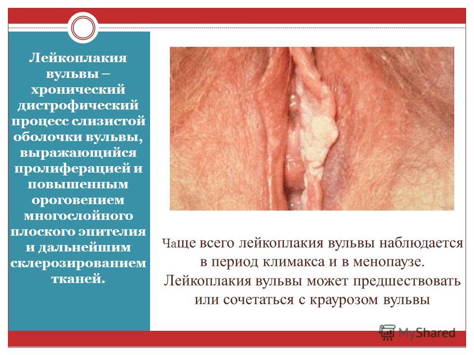 Анализ вирус папилломы человека мужчине