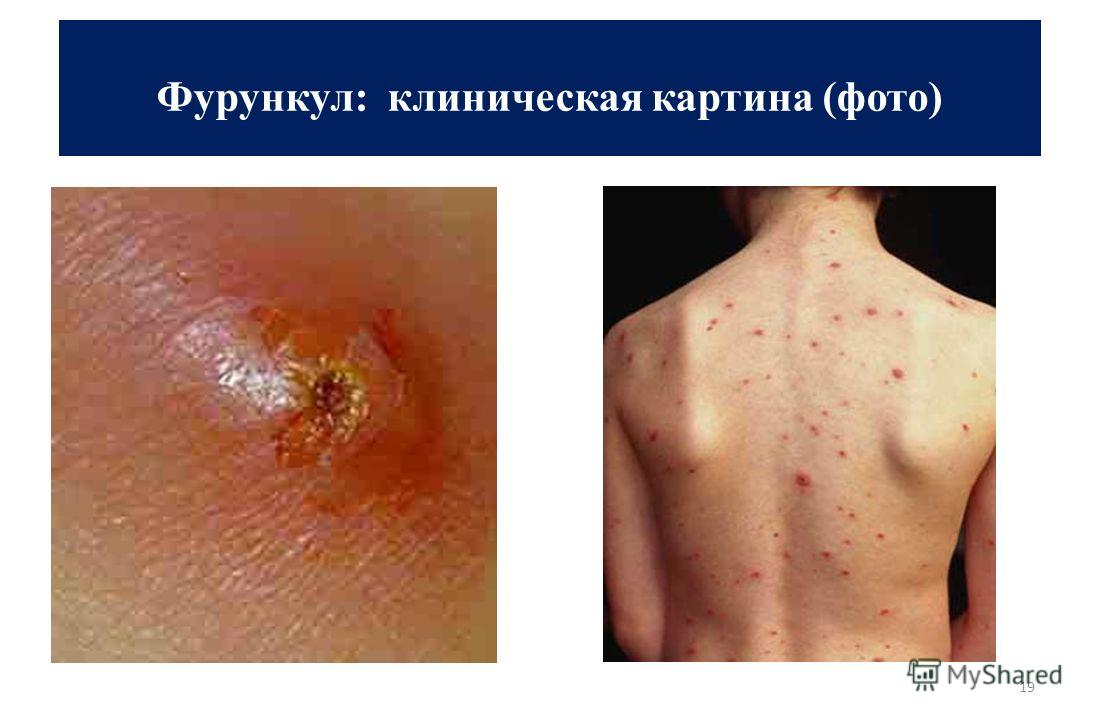 Покраснение кожи ног при сахарном диабете