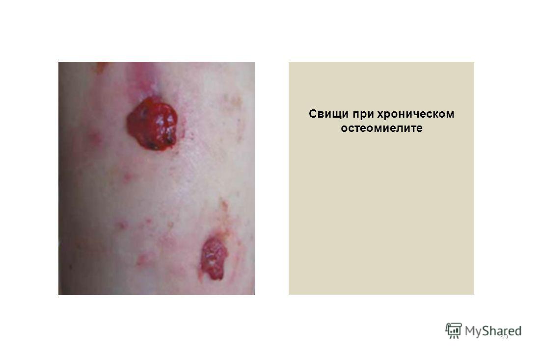 Лечение после перелома ноги отекают