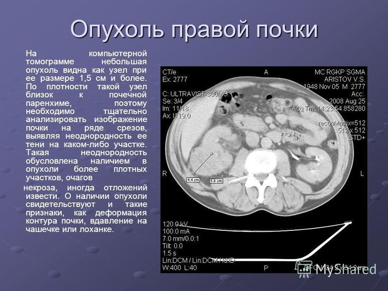 Как выглядит рак почки фото Лучевая диагностика заболеваний почек презентация