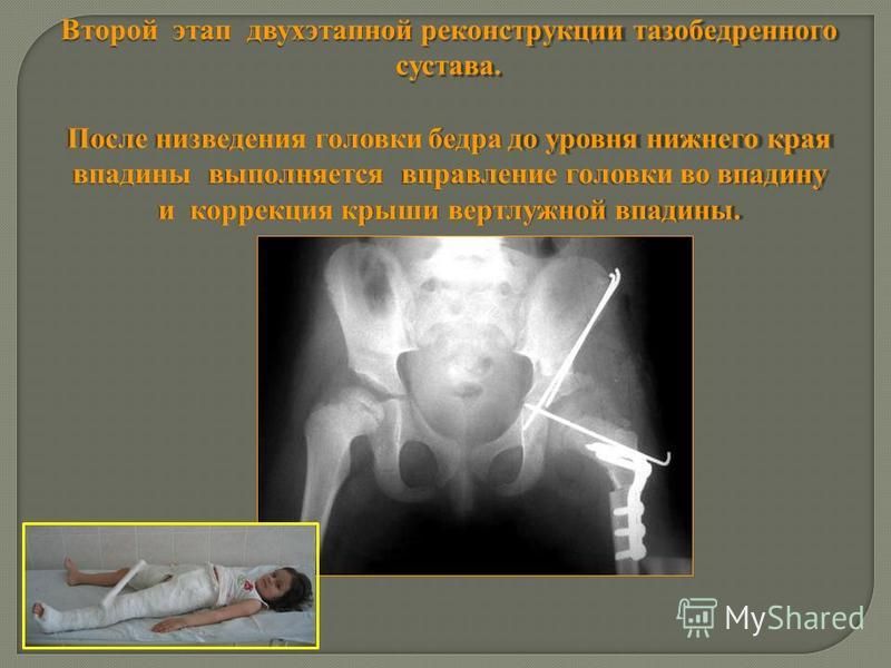 Вывих тазобедренного сустава реабилитация. Коксартроз - причины, симптомы, диагностика и лечение Вывих тазобедренного сустава у взрослых лечение – Вывих тазобедренного. Вывих тазобедренного сустава: причины, лечение, реабилитация