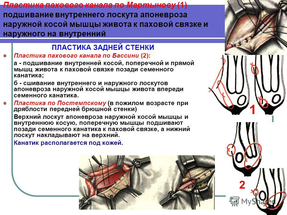 Пластика по бассини при бедренных грыжах 77