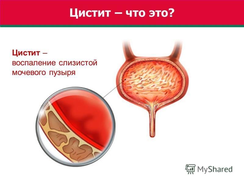 Реферат На Тему Цистит Реферат На Тему Цистит