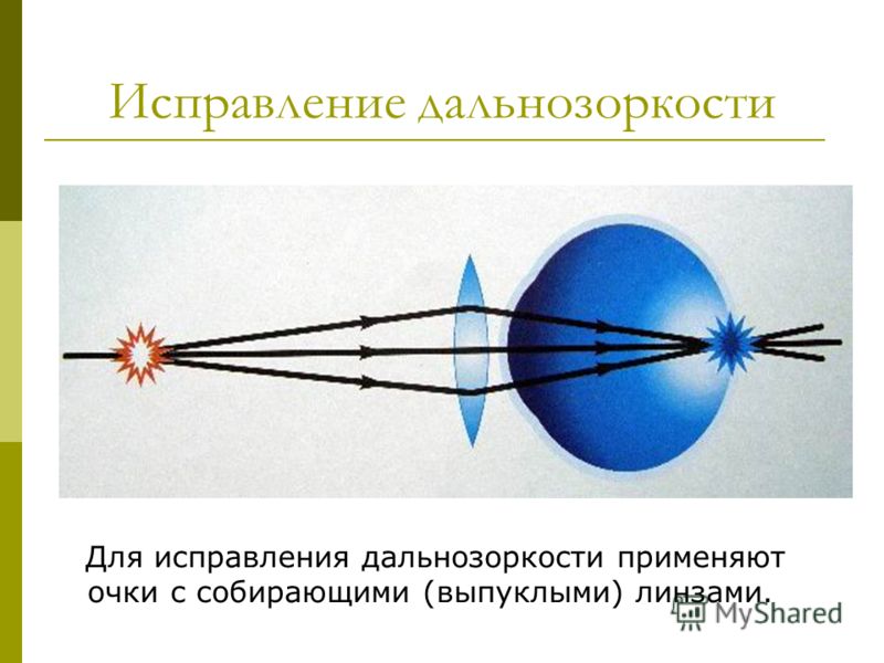 Цены на лазерную коррекцию зрения у бранчевского