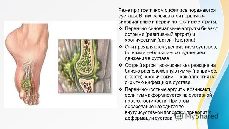 Как выглядит сифилис на руках