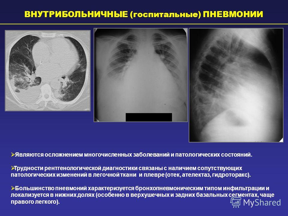 Опоясывающая боль живот беременность