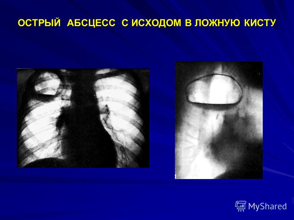 Literature Review On Tuberculosis