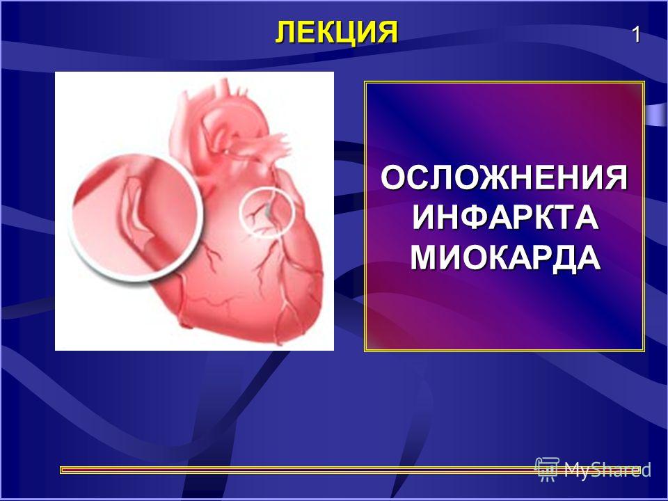 Лекция: Инфаркт миокарда. Скачать бесплатно и без регистрации Лекция: Инфаркт миокарда. Скачать бесплатно и без регистрации