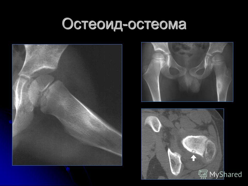Остеома симптомы