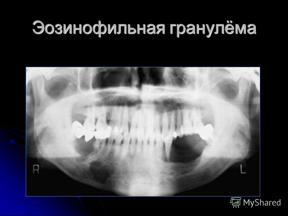 Эозинофильная гранулема у кошек