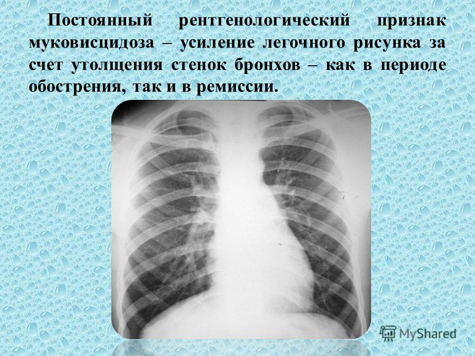 Усиление прикорневого рисунка в легких Усиление прикорневого рисунка в легких