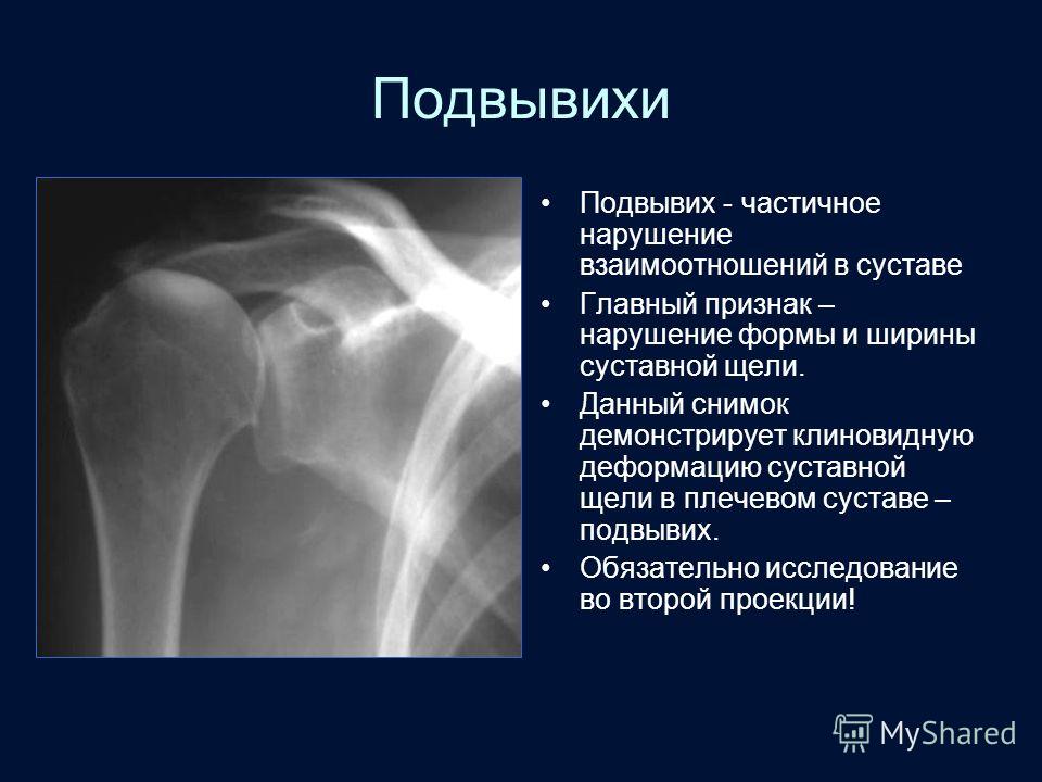 Вывихи плечевого сустава у детей Вывихи плечевого сустава у детей