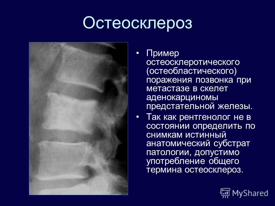 Остеолитические очаги в теле позвонка Остеолитические очаги в теле позвонка