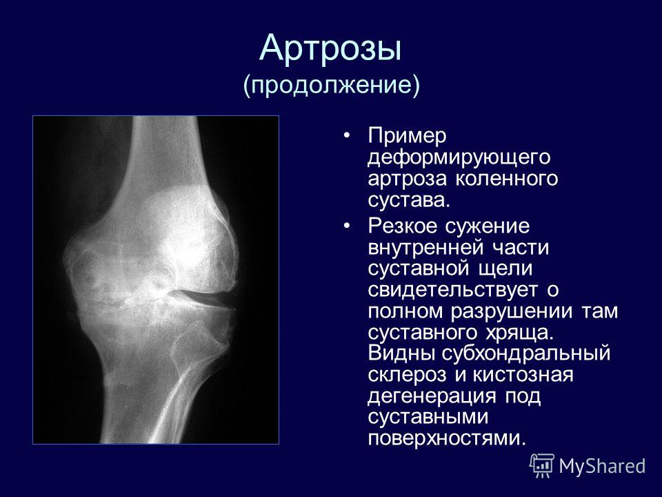 Субхондральный склероз плечевого сустава что это такое Субхондральный склероз плечевого сустава что это такое