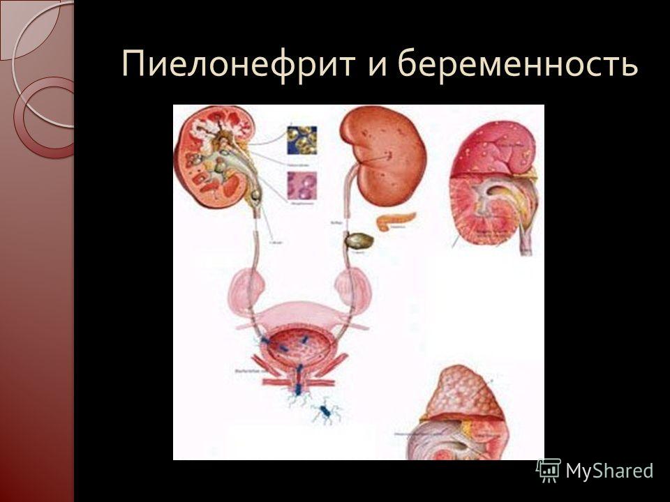 Проявление пиелонефрита у беременных 11