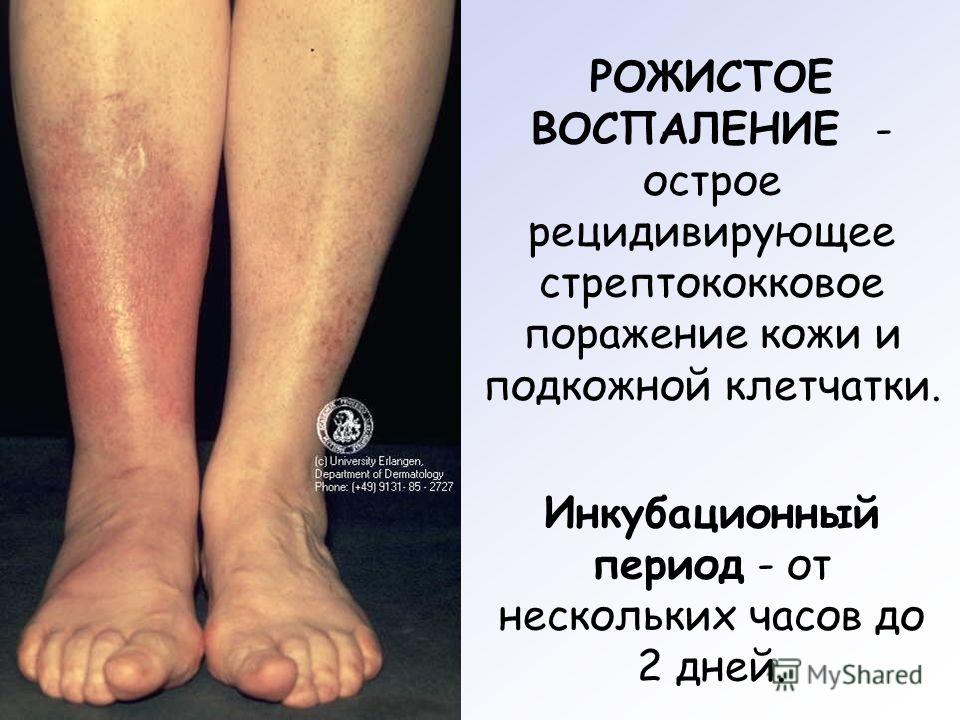 Рожистое воспаление ноги и лечение в домашних условиях Рожистое воспаление ноги и лечение в домашних условиях