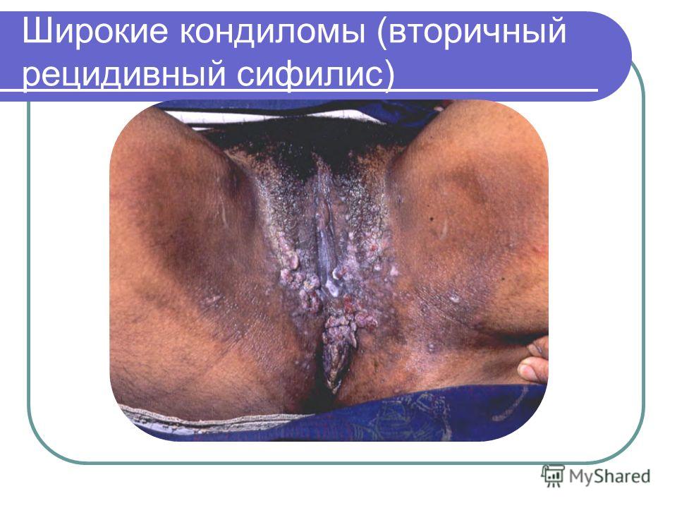 Красная родинка удаление