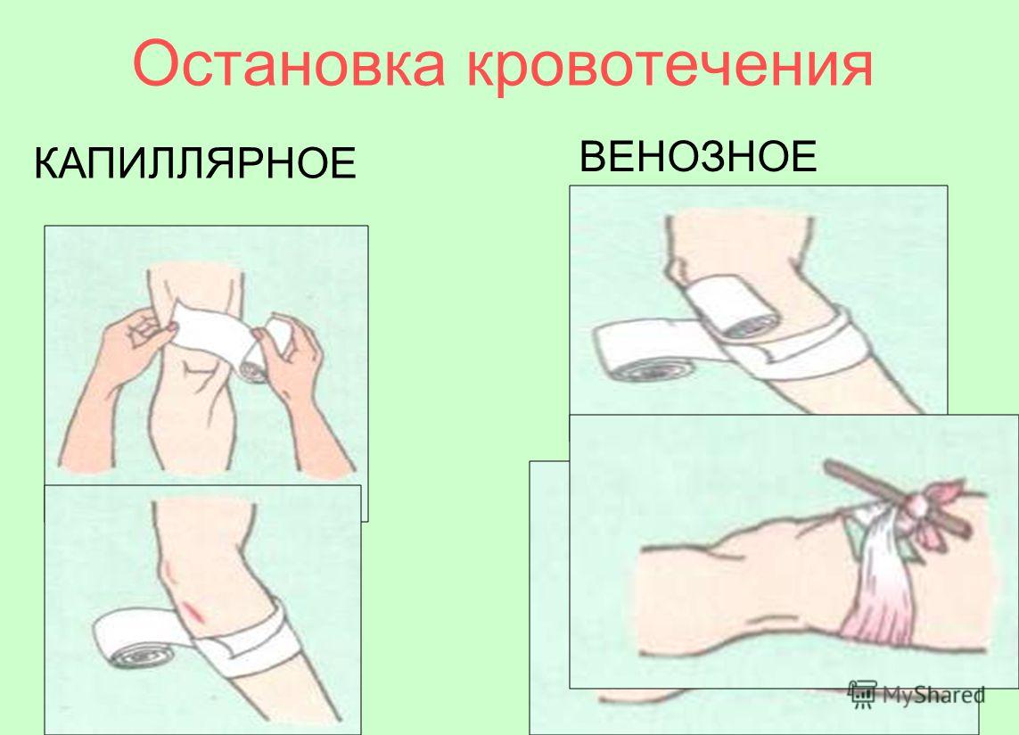 Методы остановки внешнего кровотечения Методы остановки внешнего кровотечения