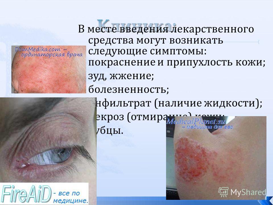 Симптом покраснение кожи и зуд Симптом покраснение кожи и зуд