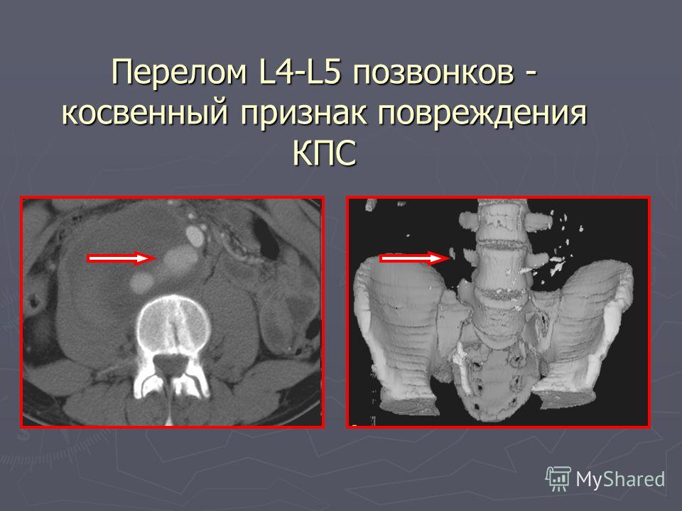 Сломать позвоночник одним ударом Сломать позвоночник одним ударом