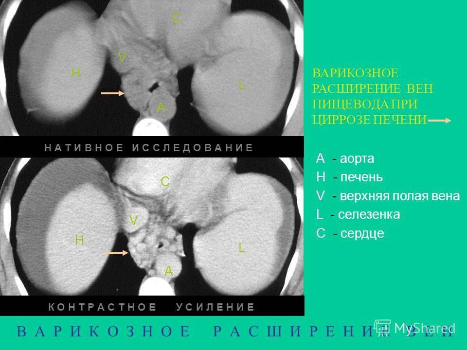 изжога и запах изо рта изжога и запах изо рта