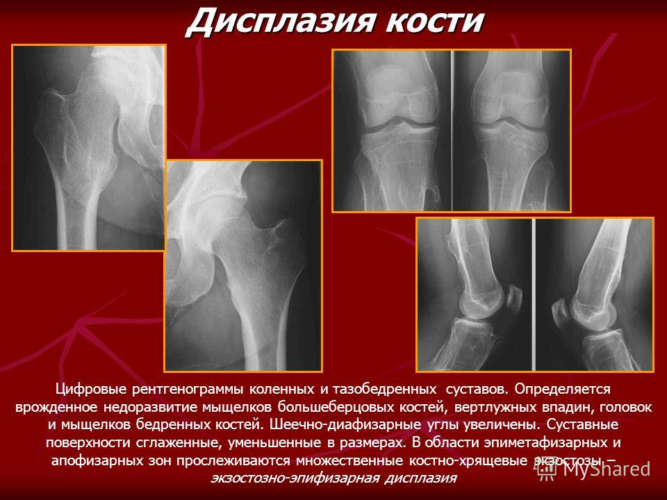 Массаж тазобедренных суставов недоразвитие тазобедренных суставов Массаж тазобедренных суставов недоразвитие тазобедренных суставов
