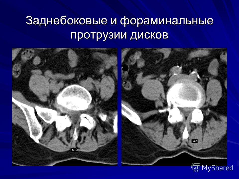 Чем отличаются протрузии от грыж межпозвонкового диска Чем отличаются протрузии от грыж межпозвонкового диска