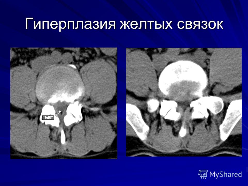 Может ли от остеохондроза быть панические атаки Может ли от остеохондроза быть панические атаки