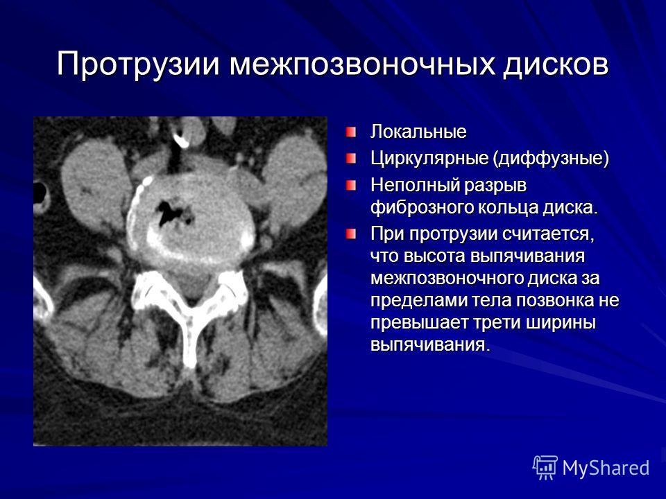 Циркулярные протрузии межпозвонковых дисков что это такое Циркулярные протрузии межпозвонковых дисков что это такое