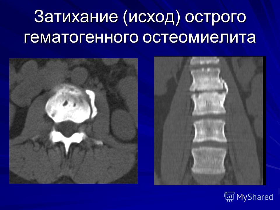 остеомиелит сустава последствия остеомиелит сустава последствия