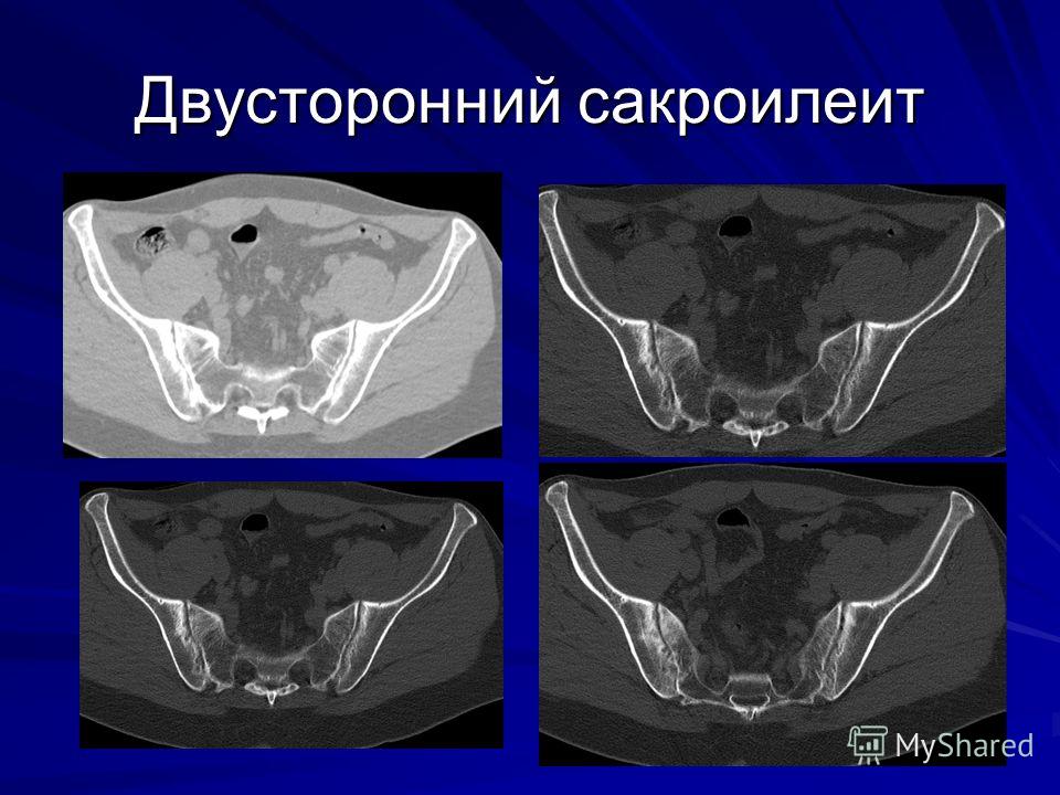 Классификация туберкулеза суставов Классификация туберкулеза суставов