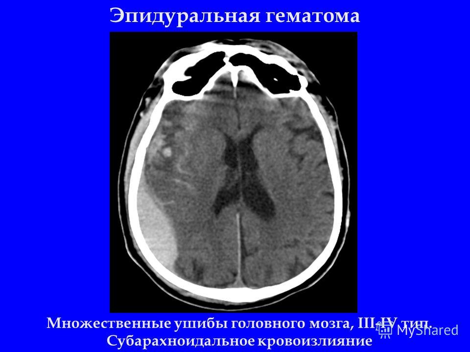 Эпидуральная гематома Множественные ушибы головного мозга, III-IV тип. Субарахноидальное кровоизлияние