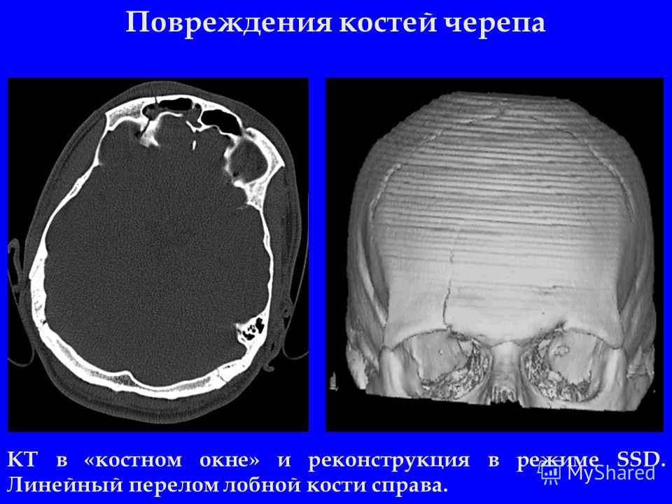 Повреждения костей черепа КТ в «костном окне» и реконструкция в режиме SSD. Линейный перелом лобной кости справа.