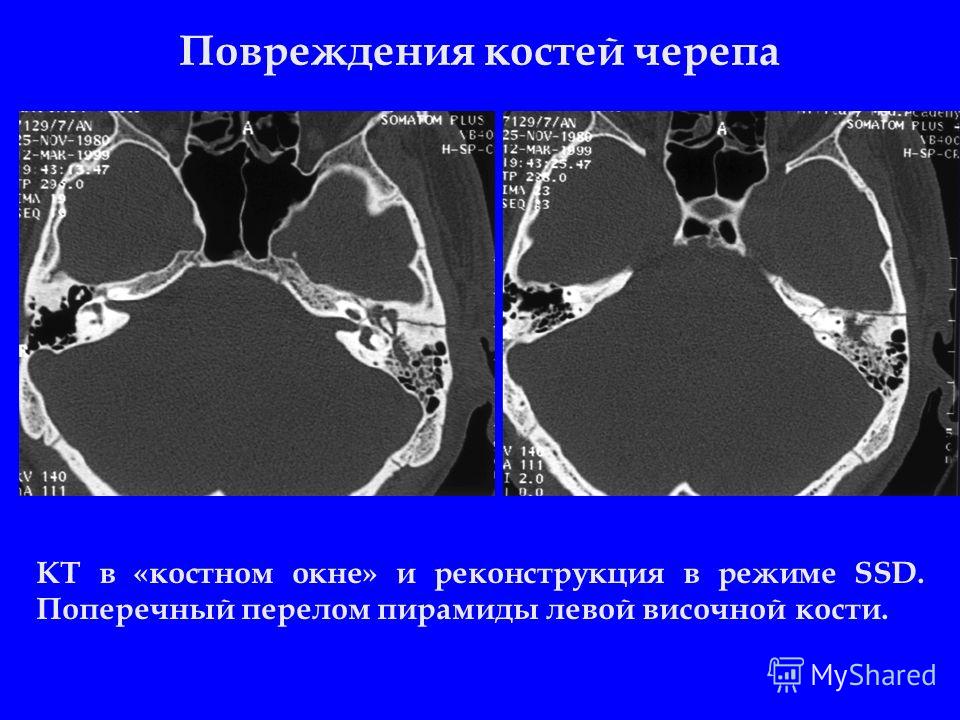 Повреждения костей черепа КТ в «костном окне» и реконструкция в режиме SSD. Поперечный перелом пирамиды левой височной кости.