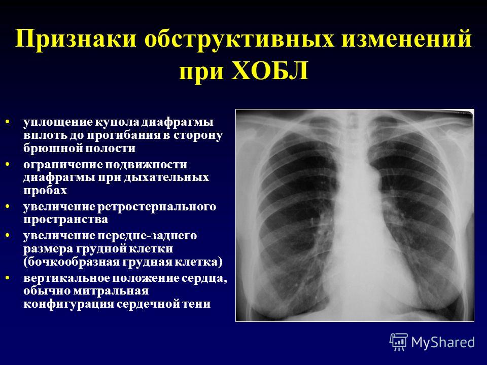 Пластика бронхов что это такое Пластика бронхов что это такое