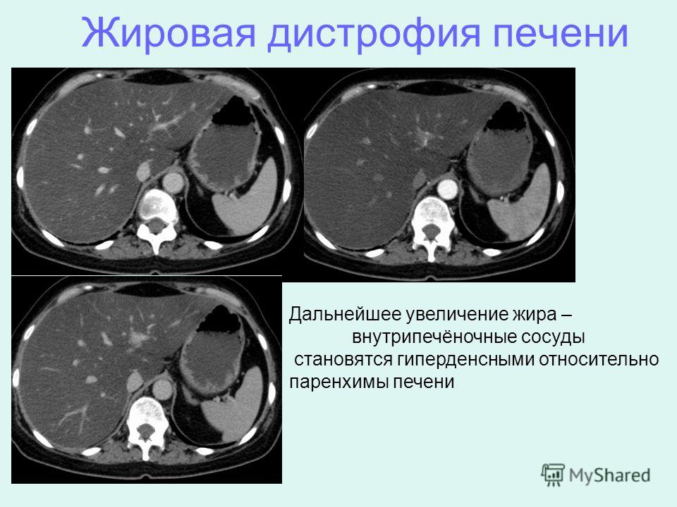 Как лечит жировой дистрофии печени в народном Как лечит жировой дистрофии печени в народном