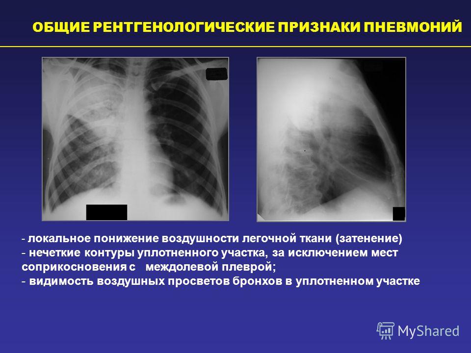 Прозрачность легочной ткани
