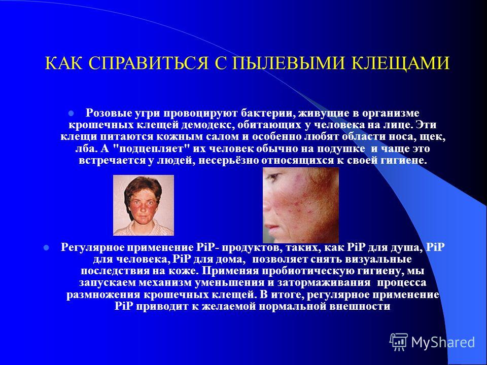 Что провоцирует угри Что провоцирует угри