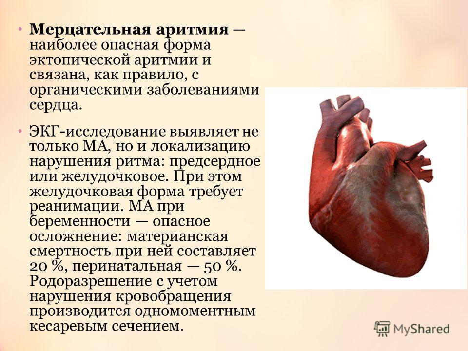 Аритмия сердца с чем это связано Аритмия сердца с чем это связано