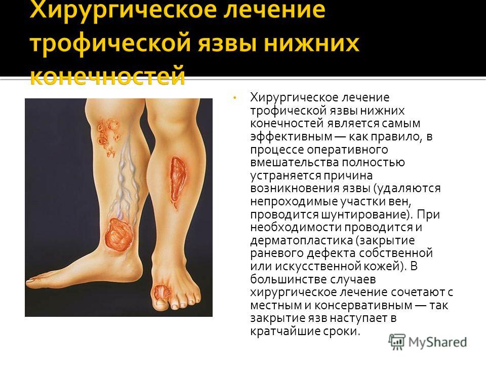 Язва на ногах лечить в домашних условиях Язва на ногах лечить в домашних условиях
